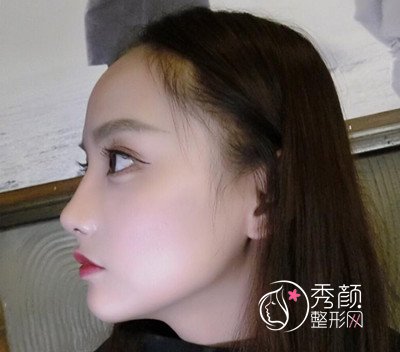 北京隆鼻哪个医生好,薛志强肋软骨鼻部手术案例分享。