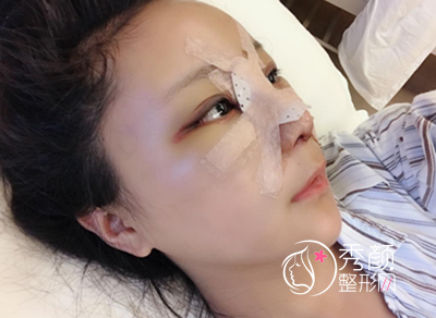 成都鼻子修复哪儿好,成都华人医联鼻修复案例分享。