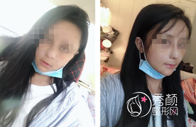 成都鼻子修复哪儿好,成都华人医联鼻修复案例分享。
