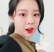 花了45000在上海韩镜赵越那儿做的全肋鼻部手术，大家看怎么样.