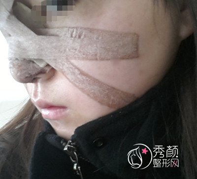 花了45000在上海韩镜赵越那儿做的全肋鼻部手术,大家看怎么样.