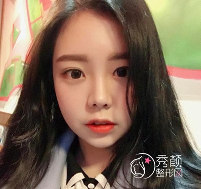 花了45000在上海韩镜赵越那儿做的全肋鼻部手术,大家看怎么样.