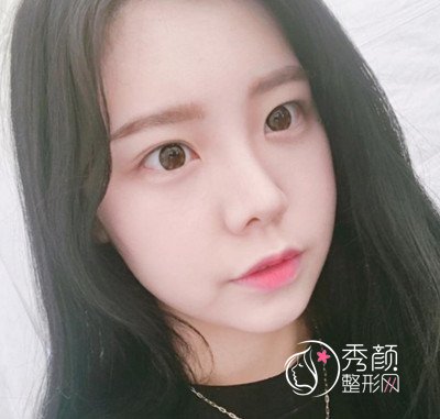 花了45000在上海韩镜赵越那儿做的全肋鼻部手术,大家看怎么样.