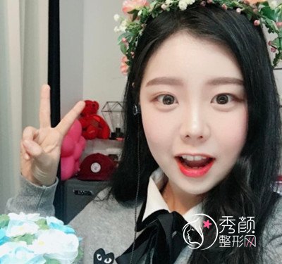 花了45000在上海韩镜赵越那儿做的全肋鼻部手术,大家看怎么样.