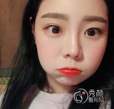 花了45000在上海韩镜赵越那儿做的全肋鼻部手术,大家看怎么样.