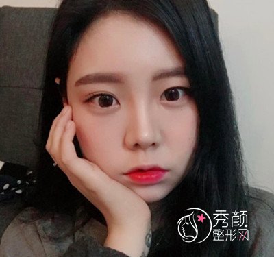 花了45000在上海韩镜赵越那儿做的全肋鼻部手术,大家看怎么样.
