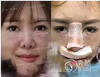 这是我第五次做鼻子了，武汉达拉斯刘波鼻修复案例过程分享。
