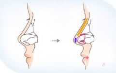 武汉隆鼻谁做的好,杨国梁、刘波、付毅、王楷、聂祝锋
