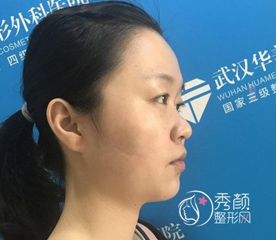 武汉华美付国友做的颧骨内推手术,已经大半年了,美丽蜕变。