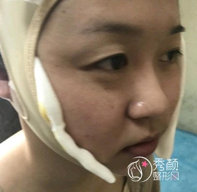 武汉华美付国友做的颧骨内推手术,已经大半年了,美丽蜕变。