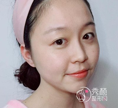 武汉华美付国友做的颧骨内推手术,已经大半年了,美丽蜕变。