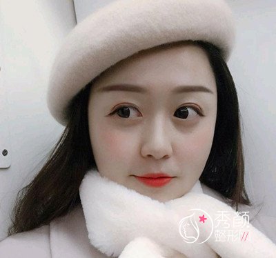 武汉华美付国友做的颧骨内推手术,已经大半年了,美丽蜕变。