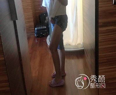分享北京清木马梅生吸脂瘦大腿案例，和大肥腿说拜拜。