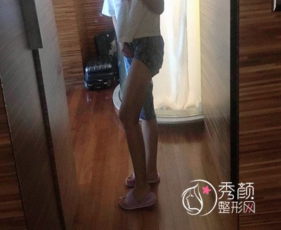 分享北京清木马梅生吸脂瘦大腿案例,和大肥腿说拜拜。
