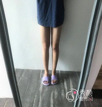 分享北京清木马梅生吸脂瘦大腿案例,和大肥腿说拜拜。