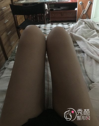 分享北京清木马梅生吸脂瘦大腿案例，和大肥腿说拜拜。
