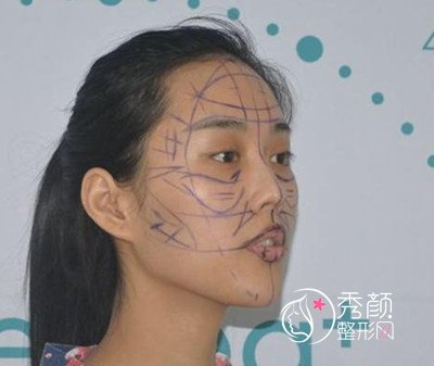 曝光我在北京禾美嘉任学会做全脸自体脂肪填充全过程。