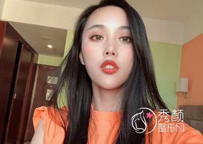 曝光我在北京禾美嘉任学会做全脸自体脂肪填充全过程。