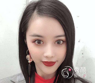 曝光我在北京禾美嘉任学会做全脸自体脂肪填充全过程。