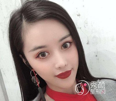 曝光我在北京禾美嘉任学会做全脸自体脂肪填充全过程。