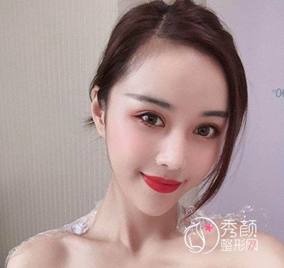 曝光我在北京禾美嘉任学会做全脸自体脂肪填充全过程。