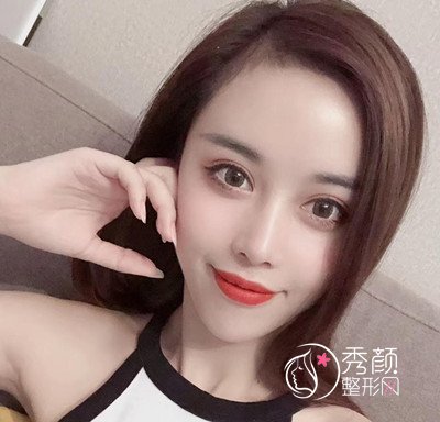 曝光我在北京禾美嘉任学会做全脸自体脂肪填充全过程。