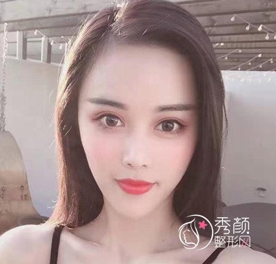 曝光我在北京禾美嘉任学会做全脸自体脂肪填充全过程。