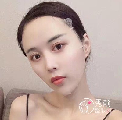 曝光我在北京禾美嘉任学会做全脸自体脂肪填充全过程。