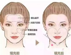 脂肪失败修复北京哪个医生好,乔爱军，任冲、王绍国、王东等。