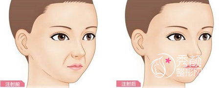 脂肪填充失败怎么办,脂肪填充失败如何修复?