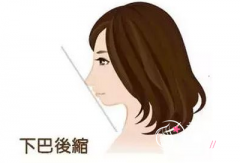 下巴后缩做矫正手术多少钱,有没有后遗症?