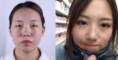 <b>上海华美割双眼皮哪个好,杨亚益、侣同帅和许再荣怎么样?</b>