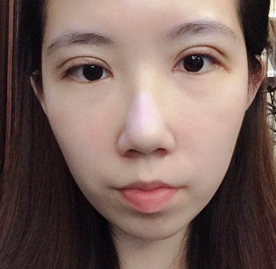 上海华美侣同帅割双眼皮案例，果真的不要太好哦。