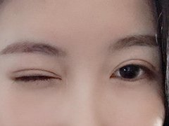 上海华美侣同帅割双眼皮案例，果真的不要太好哦。