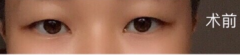 重庆艺星刘主任皮全切+去皮去脂+开眼角