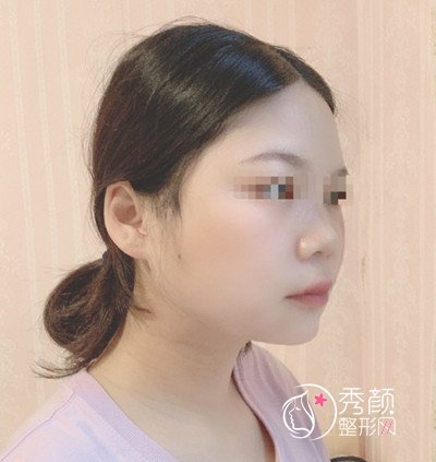 北京八大处张智勇颧骨内推 长曲线下颌角案例。