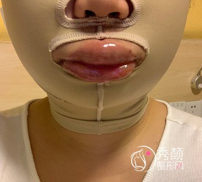 北京八大处张智勇颧骨内推 长曲线下颌角案例。