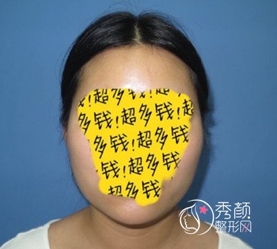 北京八大处张智勇颧骨内推 长曲线下颌角案例。