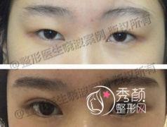 <b>八大处于晓波修复双眼皮好吗</b>
