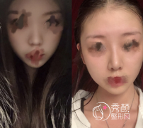 深圳乐美向宏伟肋软骨鼻部手术手术过程全纪录。