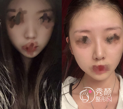 深圳乐美向宏伟肋软骨鼻部手术手术过程全纪录。