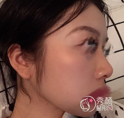 深圳乐美向宏伟肋软骨鼻部手术手术过程全纪录。