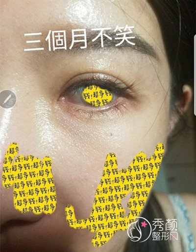 做了自体筋膜丰卧蚕满三个月了，写一下功课吧