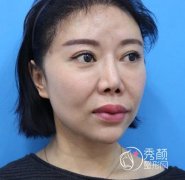 在北京加减美做的V美减龄面部年轻化，年轻了不止一点点。