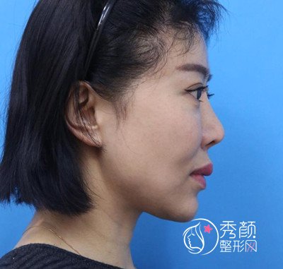 在北京加减美做的V美减龄面部年轻化，年轻了不止一点点。
