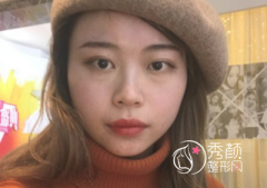 成都心悦容徐航隆鼻案例。