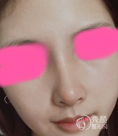 花了近8万人民币在成都倪云志做的鼻子案例分享。