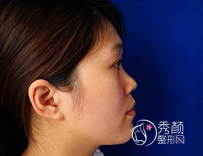 上海九院奥美定取出+肋软骨隆鼻+苹果肌填充案例。