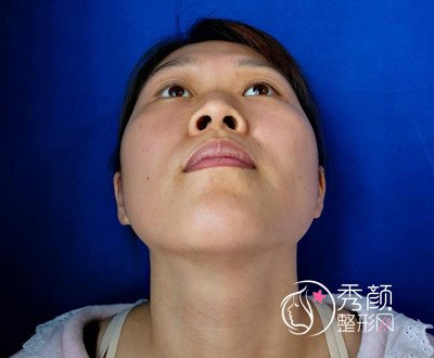 上海九院奥美定取出+肋软骨隆鼻+苹果肌填充案例。