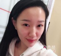 北京联合丽格吴焱秋割双眼皮+开眼角案例。